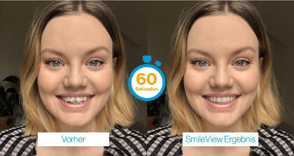 Invisalign SmileView