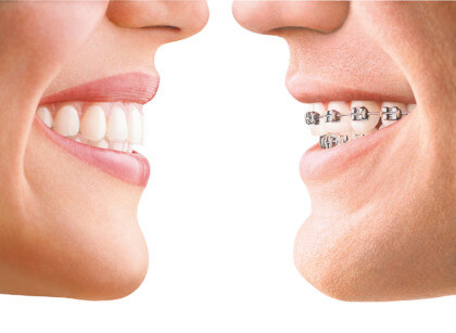 Invisalign vs. Metallbrackets